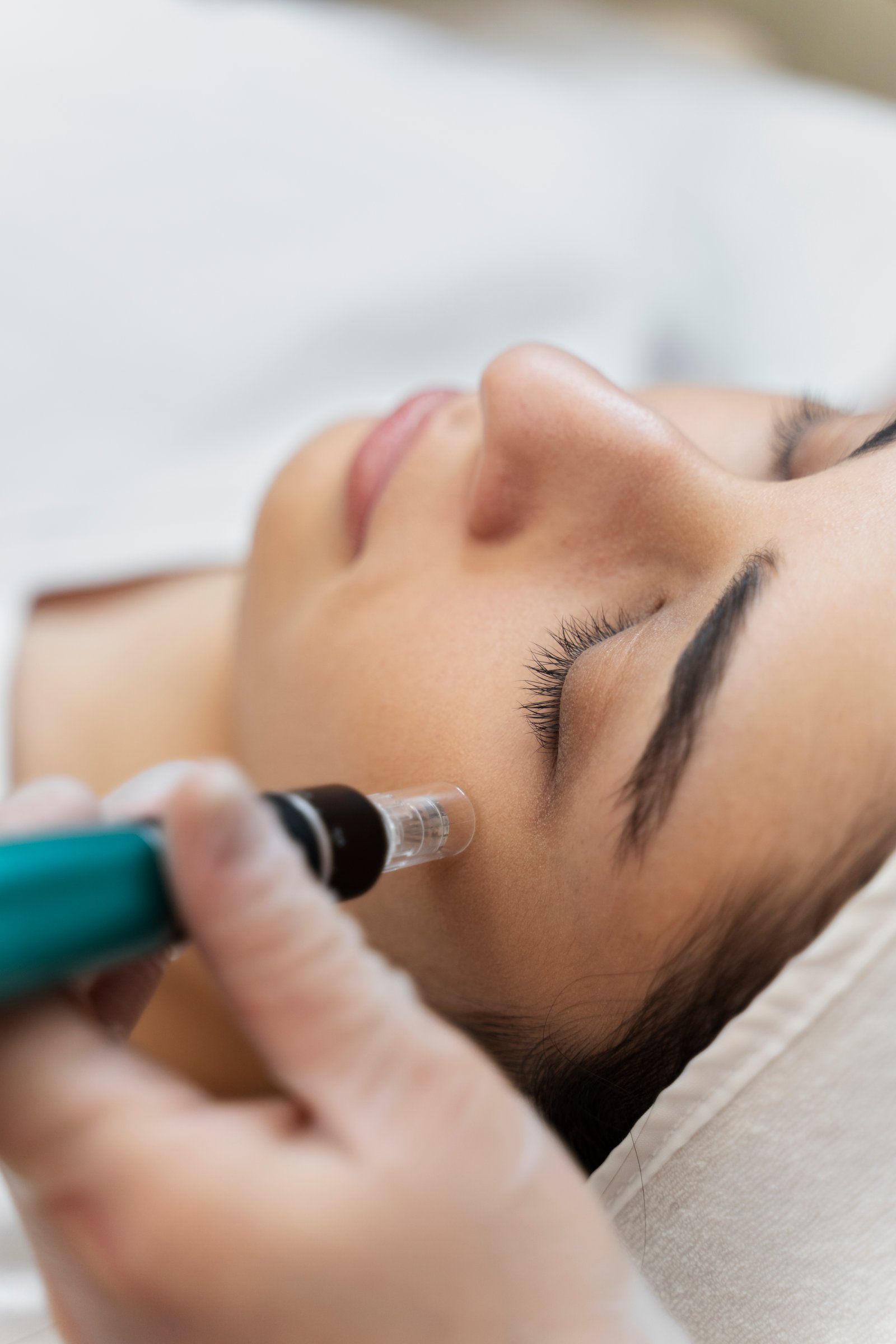 Laser hair removal